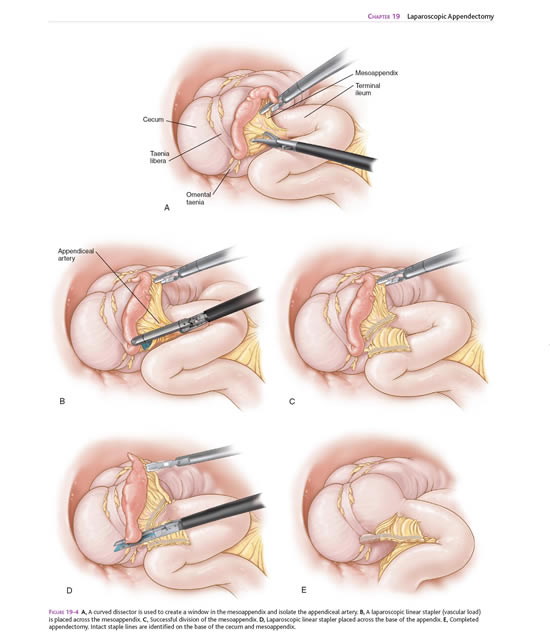 appendectomy