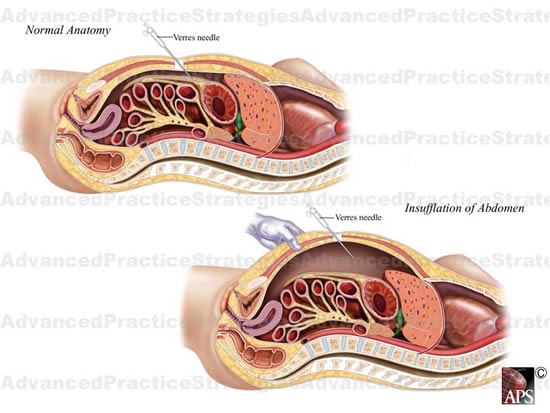 diagnostic_laparoscopy