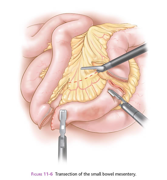 enterectomy