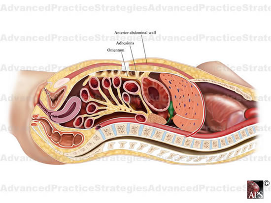 enterolysis2