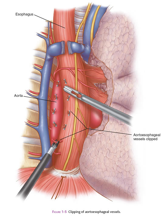 esophagectomy1