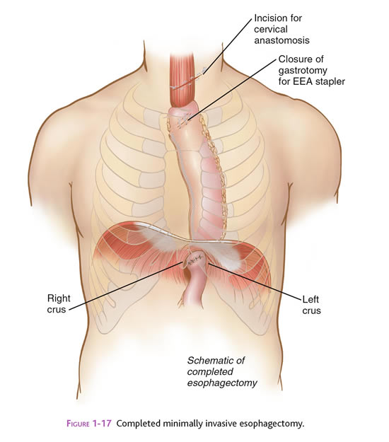 esophagectomy2