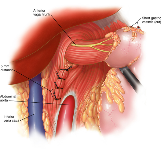 hernia11