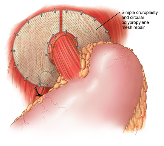 hernia12