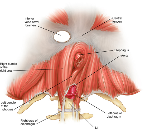 hernia6