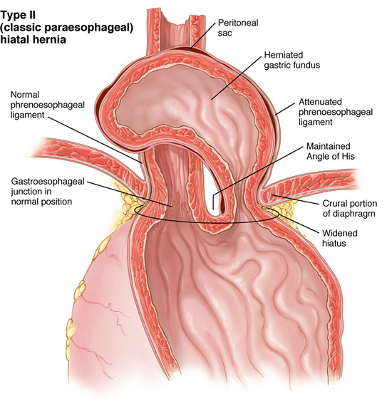 What are the risks of a hiatal hernia surgery?