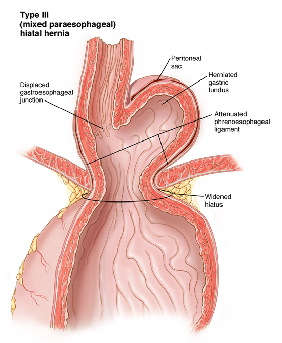 hernia9