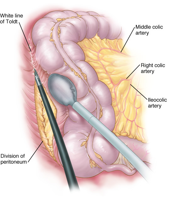 lap_olectomy2