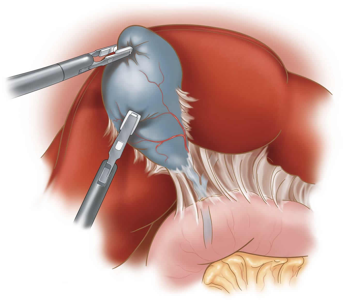 laparoscopic-cholecystecomy-b