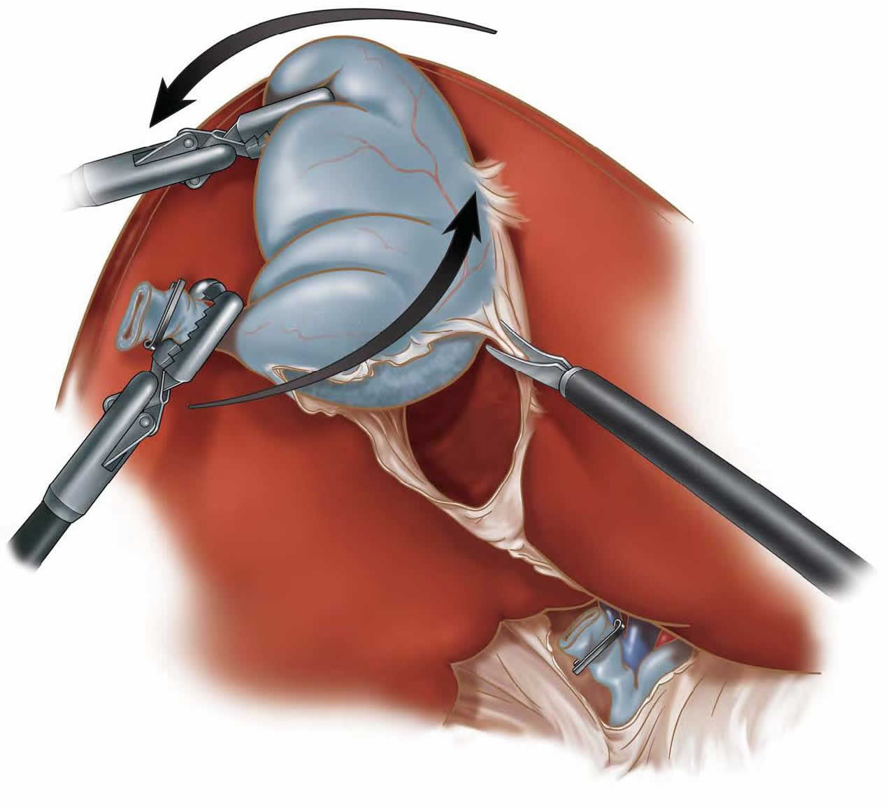 laparoscopic-cholecystecomy-c