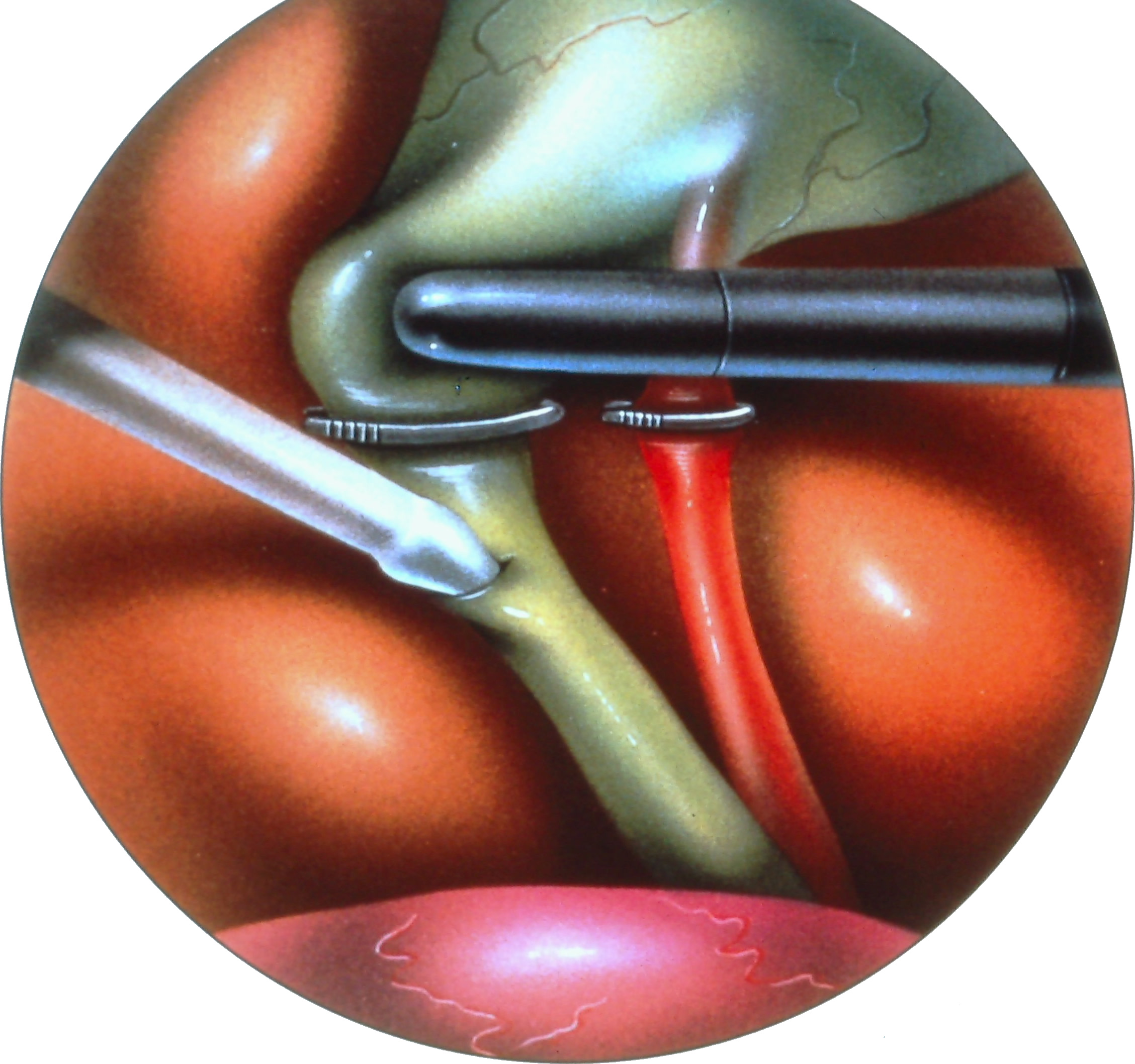 laparoscopic-common-bile-duct-exploration-1