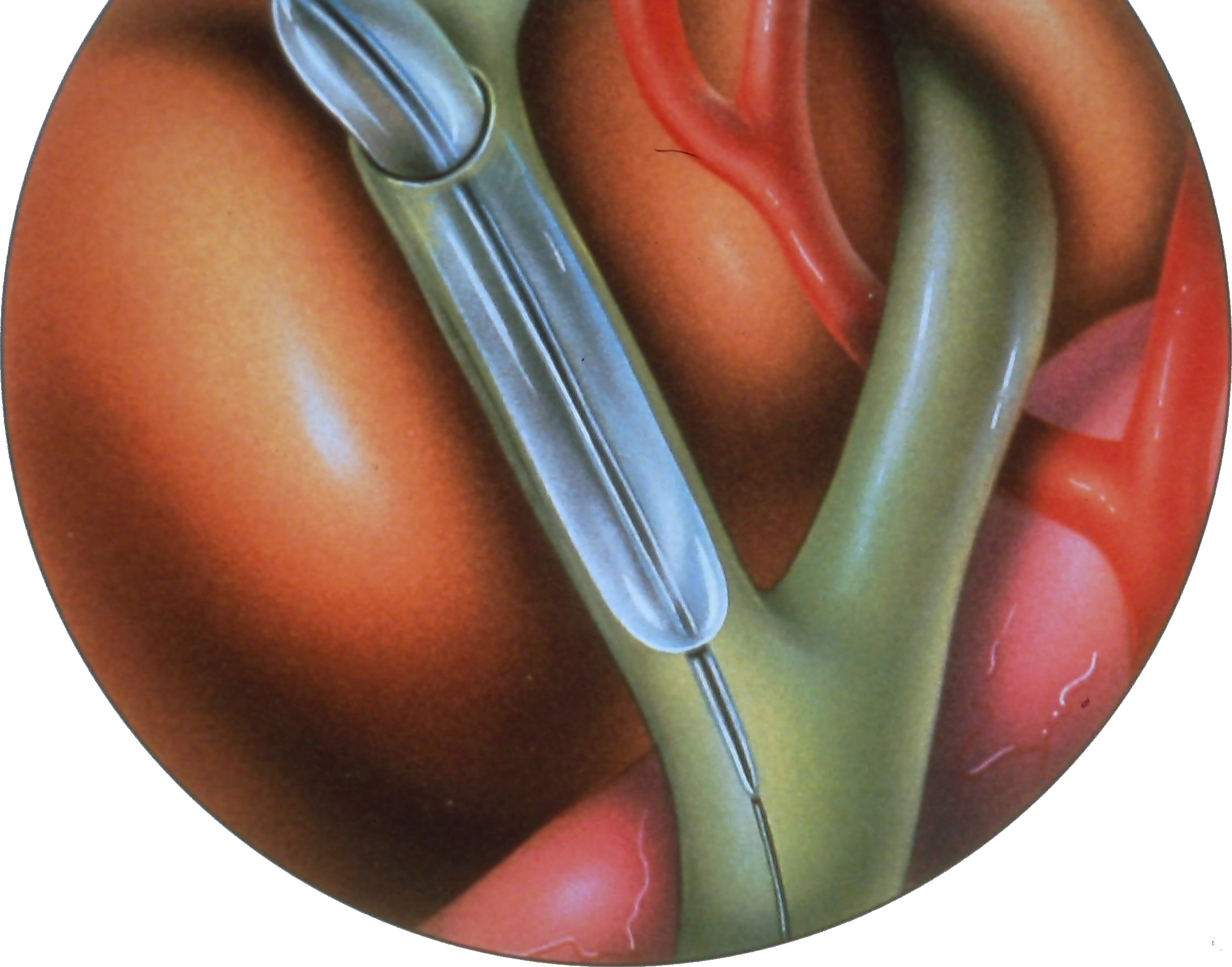 laparoscopic-common-bile-duct-exploration-2