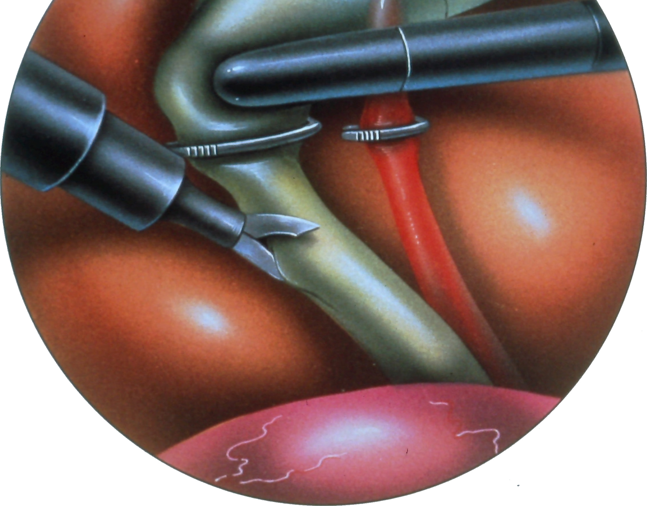 laparoscopic-common-bile-duct-exploration