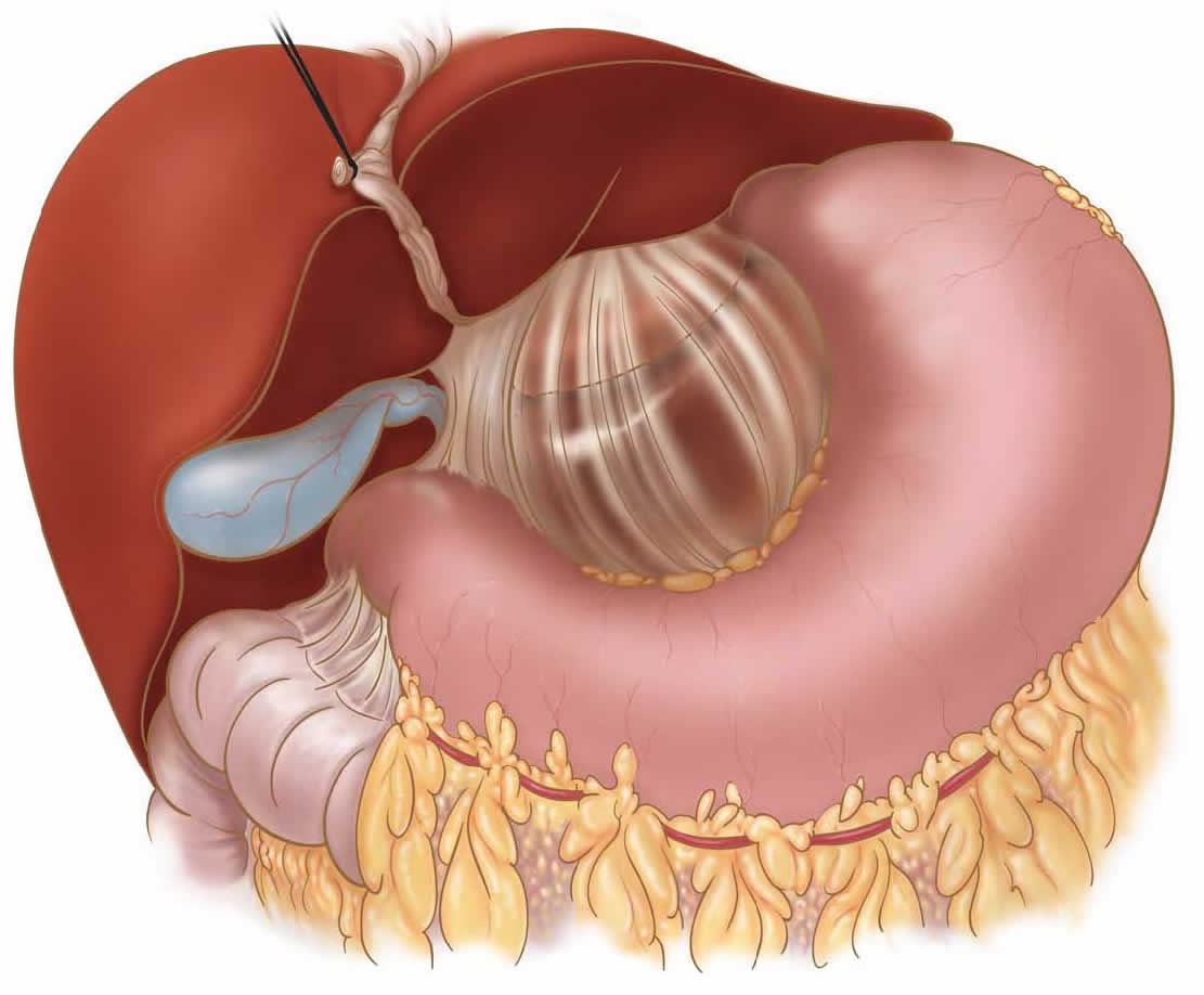 laparoscopic-drainage-pancreatic-pseudocyst-b