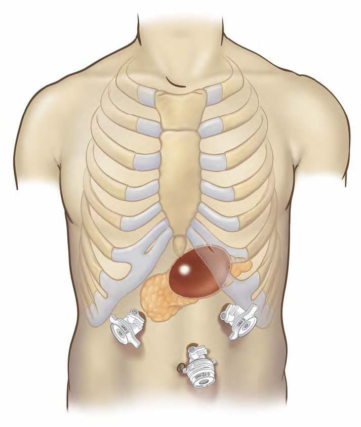 laparoscopic-drainage-pancreatic-pseudocyst