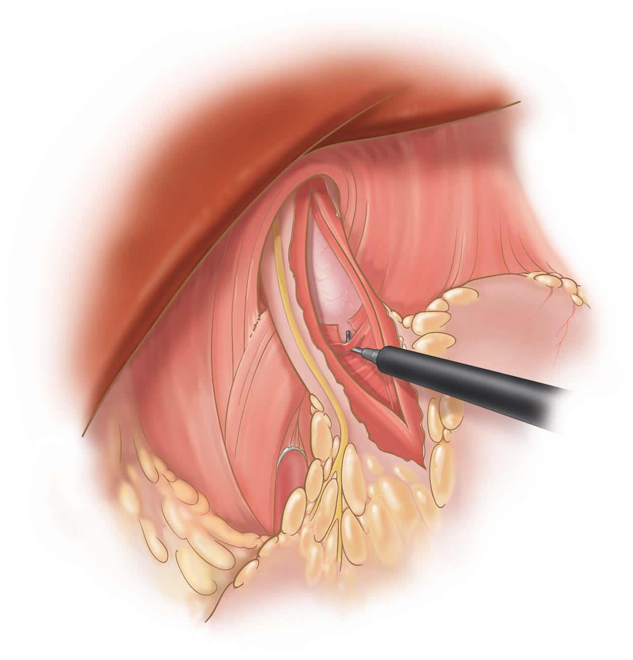 laparoscopic-esophagomyotomy