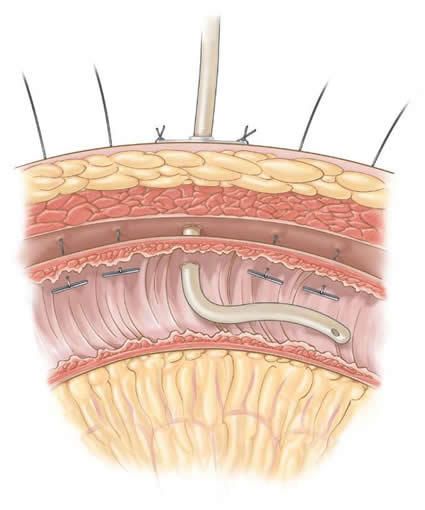 laparoscopic-feeding-gastrostomy-jejunostomy-b