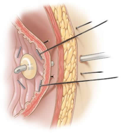 laparoscopic-feeding-gastrostomy-jejunostomy