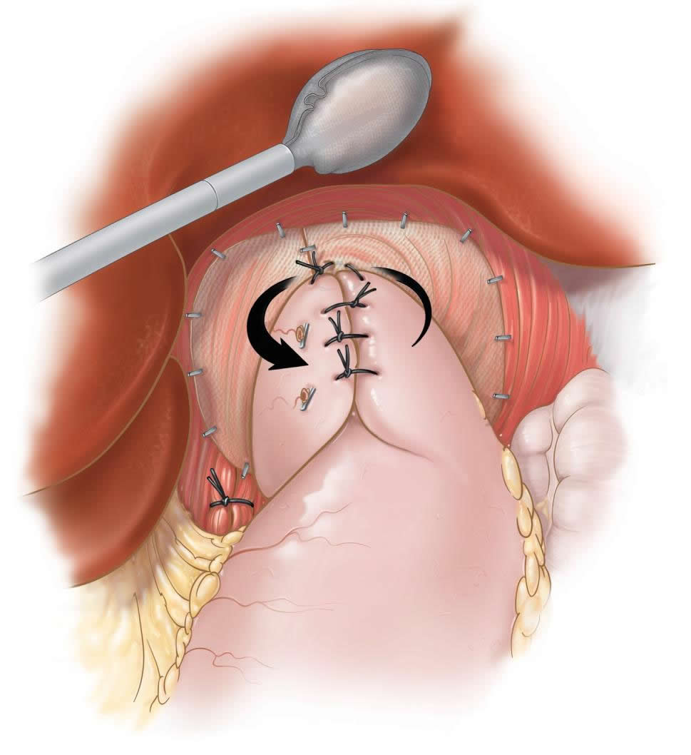 laparoscopic-fundoplication