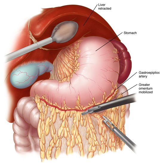 laparoscopic-gastrectomy