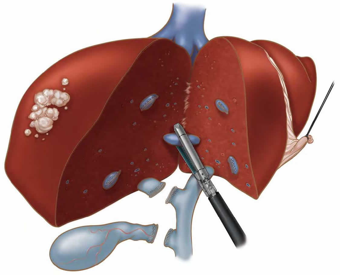 laparoscopic-liver-biopsy-hepatectomy