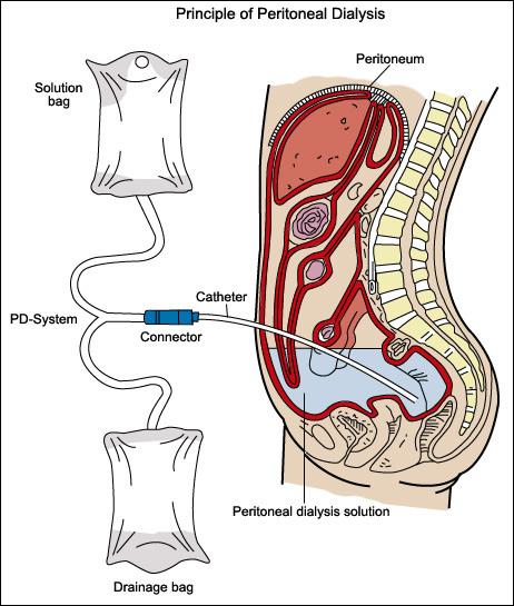 laparoscopic-peritonial-dialysis-catheter