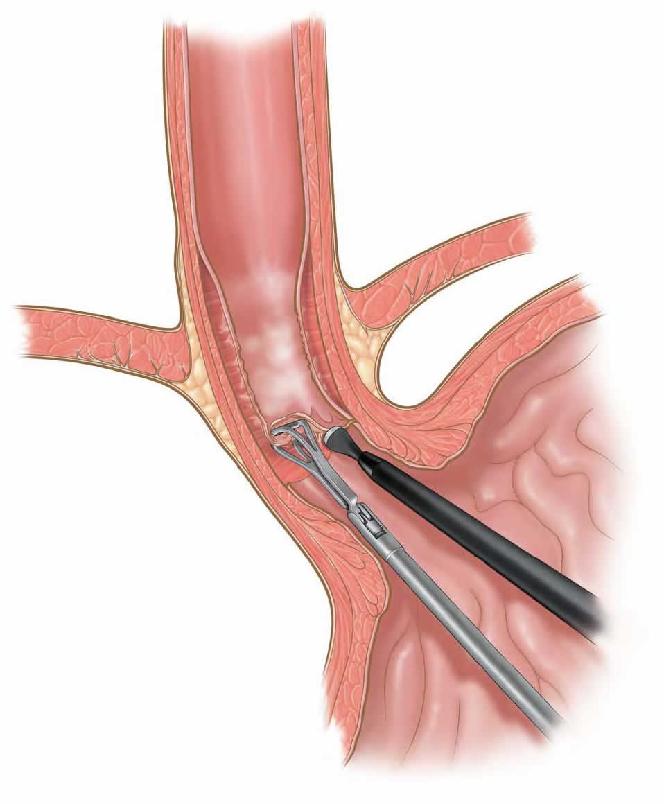 laparoscopic-transgastric-esophageal-mucosal-resection-b