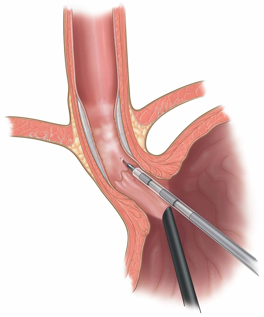 laparoscopic-transgastric-esophageal-mucosal-resection