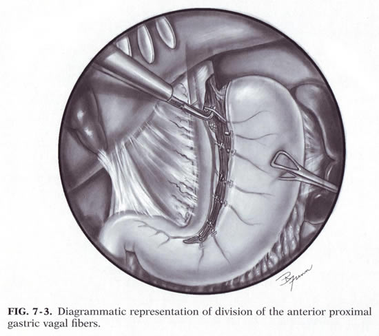 laparoscopic-vagotomy