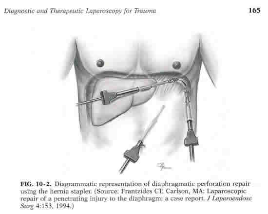 laparoscopic_diaphragmatic2