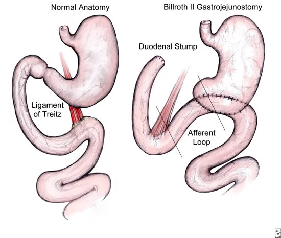 laparoscopic_gastrojejunostomy