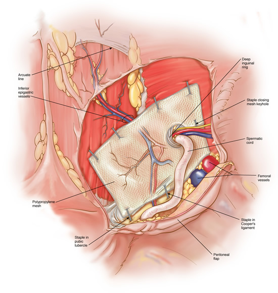 What happens during laparoscopic hernia repair?