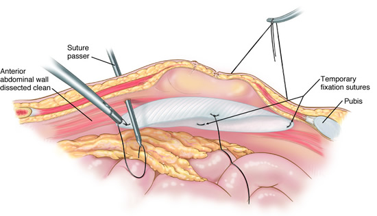 laparoscopic_ventral2