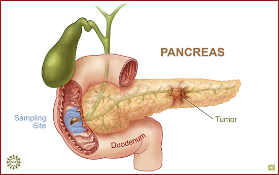 pancreatectomy