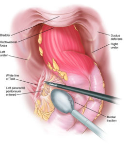 Endocolectomy Resection of Large Intestine and Rectum